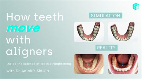 How do aligners work to move teeth? - Straight Teeth Direct