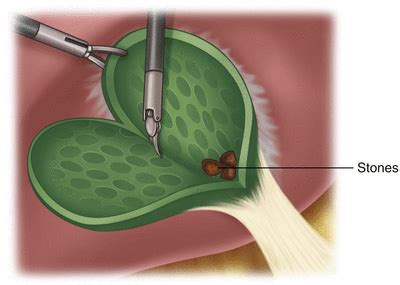 Partial Cholecystectomy | Anesthesia Key