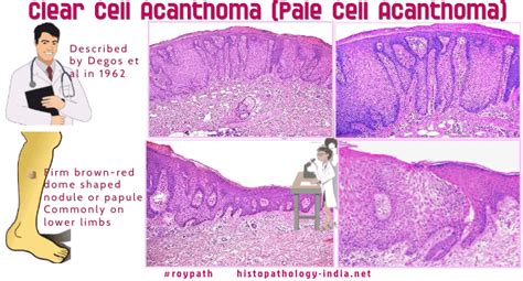 Clear Cell Acanthoma Histology