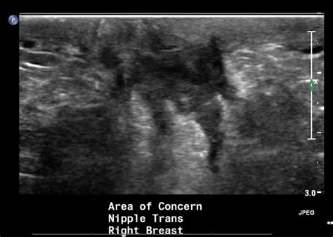 Acute Mastitis