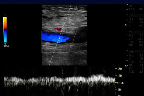 Venous Duplex Ultrasound Test in Naples, FL | Naples Cardiac ...