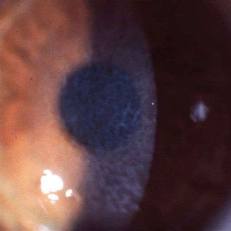 All of the following are anterior dystrophies except? - MCQ