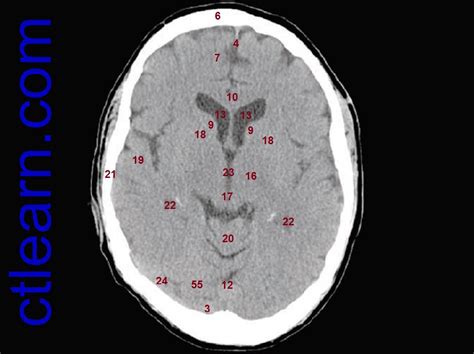 Learn CT Scan: Anatomy CT Axial Brain