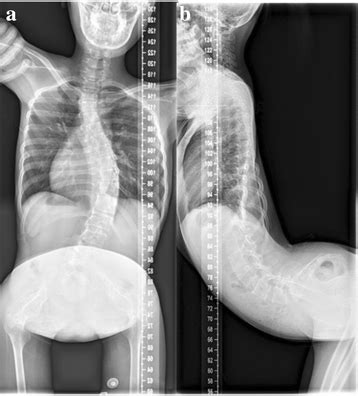 Surgical correction of hyperlordosis in facioscapulohumeral muscular dystrophy: A case report ...