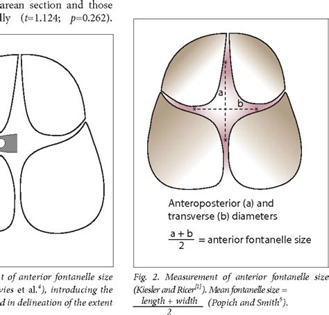 Figure 1 from Normal anterior fontanelle sizes in newborn Igbo babies in south-eastern Nigeria ...