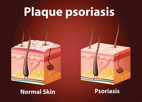 Best Plaque Psoriasis Illustrations, Royalty-Free Vector Graphics & Clip Art - iStock