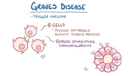 Graves disease - Osmosis