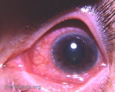 Viral keratoconjunctivitis. EyeRounds.org: Online Ophthalmic Atlas