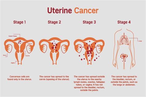 Uterine (Endometrial) Cancer: Types, Risk Factors, Symptoms & Treatment ...