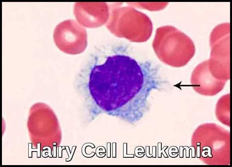 Hairy Cell Leukemia | Ask Hematologist | Understand Hematology