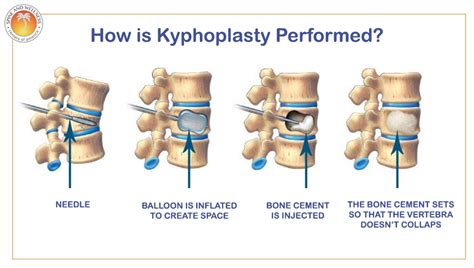 Kyphoplasty for Spine Fractures South Florida | SWCA