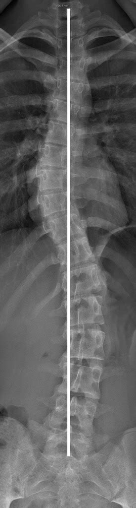 Scoliosis x ray - wikidoc
