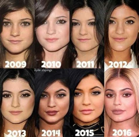 Kylie Jenner's face - Before & After surgery