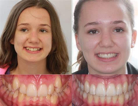 Before & After Magic, Transformational Power of Braces on Teeth