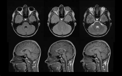 Brain Bleed: Brain Bleed On Mri