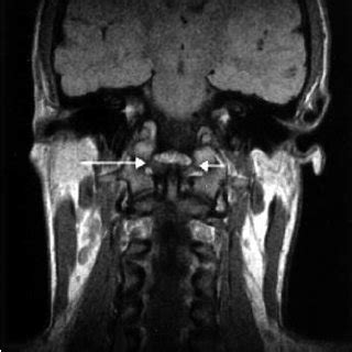 Sagittal scan demonstrating a grade-1 alar ligament ( arrow ) | Download Scientific Diagram