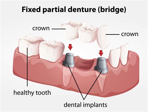 Fixed partial denture bridge