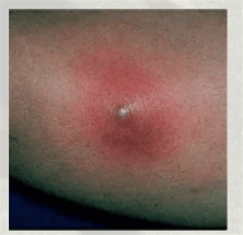 Spider Bites: Scary Skin Staph Stuff - Orange County Pediatric and ...