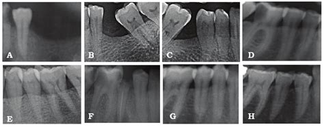 Radiographic results of group 1 showing: A) generalized horizontal bone ...