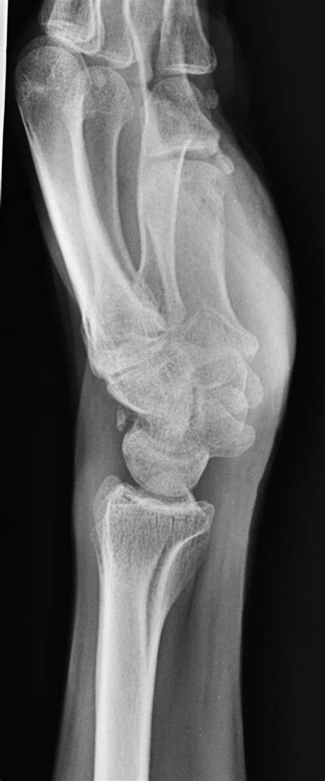 Triquetral fracture | Image | Radiopaedia.org