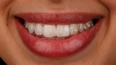 Invisalign Clears The Way To A Great Smile With Dentistry of Miami