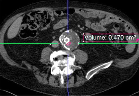 Type II Endoleak Nidus Volume on Arterial and Delayed Phases of Initial ...