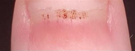 nailfold capillary changes? : r/scleroderma