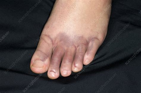 Bruised foot from running - Stock Image - C008/5763 - Science Photo Library