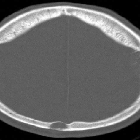 Thoracic-abdominal-pelvic (TAP) CT scan -bone window: osteolytic lesion... | Download Scientific ...