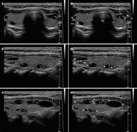 Thyroid Cysts | Radiology Key