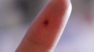 Blood clot in finger: 5 Causes, Symptoms, 10 Home Remedies