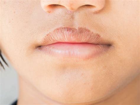 How to get rid of chapped lips: 6 ways