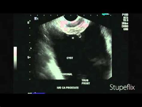 Ultrasound video of cystitis cystica - YouTube