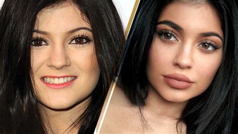 Kylie Jenner's Lips: How To Remove Filler — Mixed Makeup