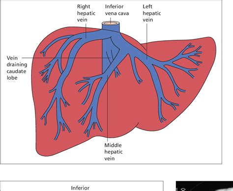 Figure 9.63 from The Hepatic Artery, Portal Venous System and Portal ...