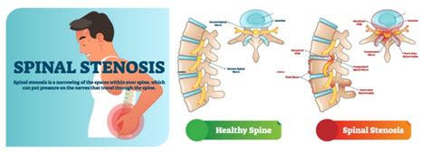 What Causes Spinal Stenosis? - New Mexico Orthopaedic Associates