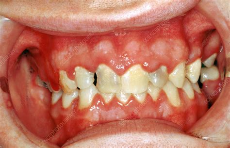 Acute Herpetic Gingivostomatitis - Stock Image C036/5836 - Science Photo Library