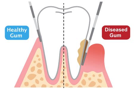 Periodontal Pockets | Complete Dental Care | San Jose, CA