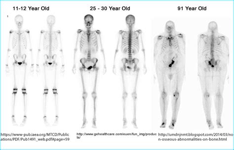 Spect Bone Scan