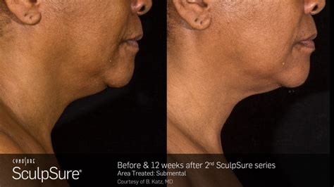 SculpSure before and after Photos: Real Patient Results - New Beauty ...