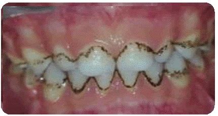 What causes teeth to stain or discolour? - Hartwell Dentistry, Dentist Camberwell