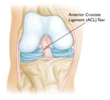 Understanding Knee Injuries - Ask The Nurse Expert