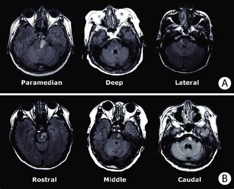 Paramedian Pontine Infarct