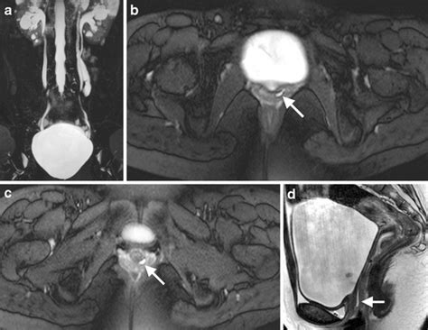 Ectopic ureter in a 14-year-old girl with autosomal-dominant polycystic... | Download Scientific ...