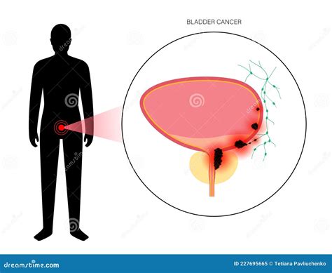 Bladder cancer stages stock vector. Illustration of ureter - 227695665