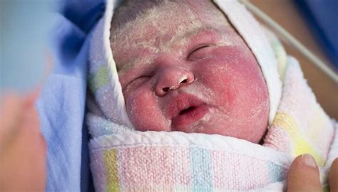 Newborn skin peeling: Causes, treatment, and home remedies