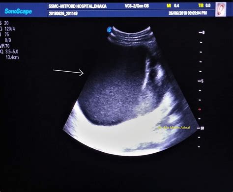 Case 07: Retroperitoneal Hematoma Ultrasound ~ Imaging Study