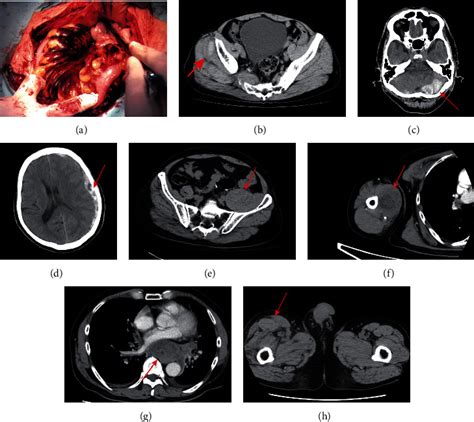 Autoimmune Factor V Deficiency in 70-Year-Old Patient