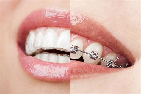 Invisalign® vs Traditional Orthodontics - Skillman, NJ Braces Alternatives