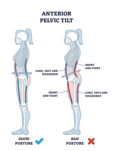 How To Fix Anterior Pelvic Tilt Posture - Chatfield Family & Sports ChiropracticChatfield Family ...